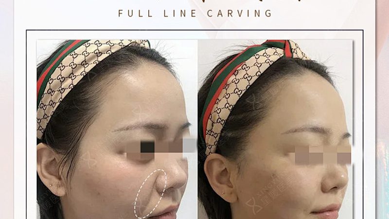 小标题：双眼皮手术，揭秘恢复过程