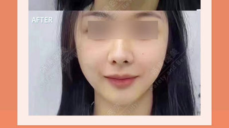 热玛吉2025：揭秘热玛吉价格背后的选购秘诀