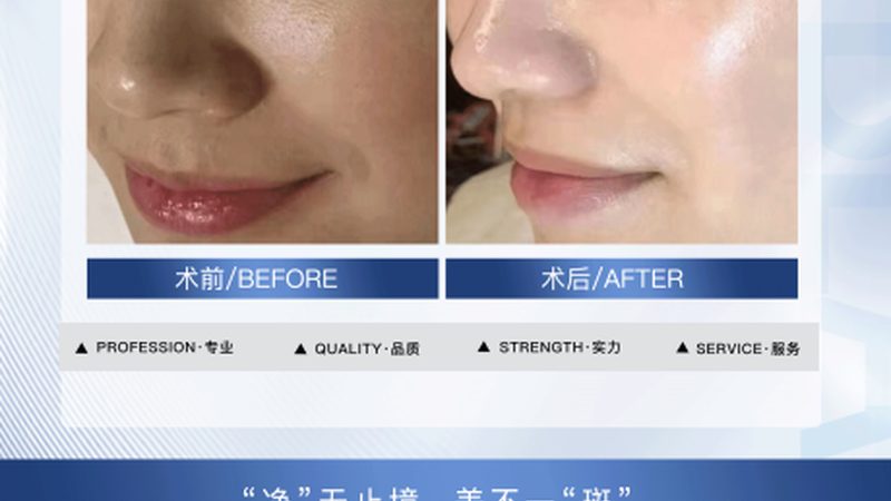 热玛吉2025价格解析：揭秘疗程次数与标准