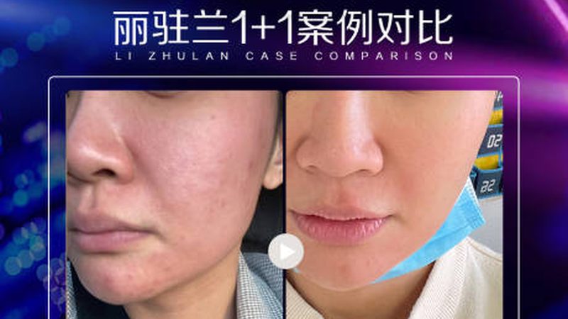 成都双眼皮手术风险咨询