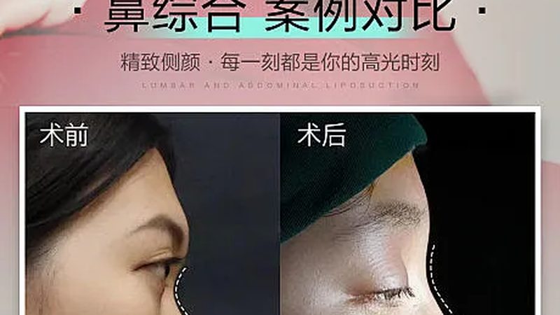 全切双眼皮术后，这些注意事项你做到了吗？**